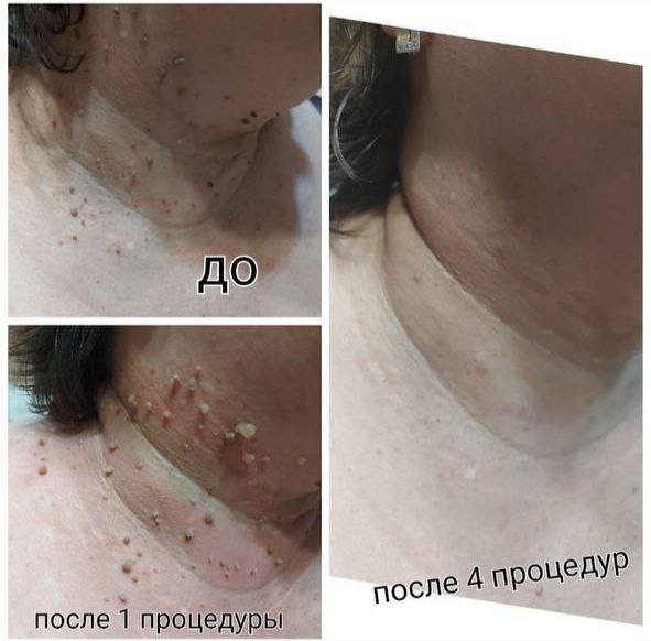 Активатор клеток: отзывы и результаты применения при папилломах (до и после)
